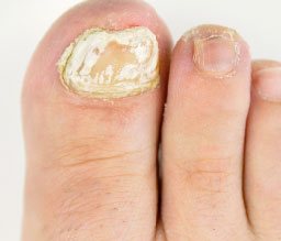 Nail distorded in shape may be a sign of a nail fungal infection