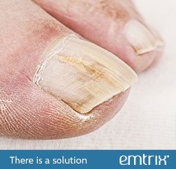 Dull, with no lustre or shine nail. There is a solution: Emtrix