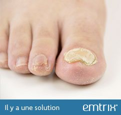 Thickened nail. There is a solution: Emtrix