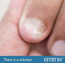 Brittle, crumbly or ragged nails. There is a solution: Emtrix