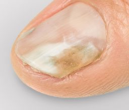 Dark coloured nail may be a sign of a nail fungal infection