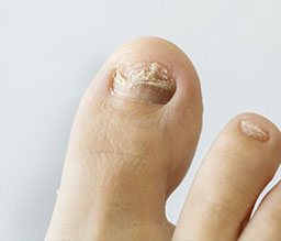 Nail separated from the nail bed may be a sign of a nail fungal infection