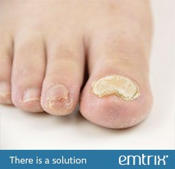 Thickened nail. There is a solution: Emtrix